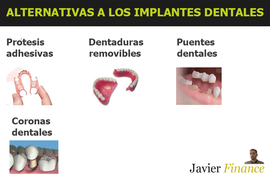 Alternativas más baratas a los implantes dentales